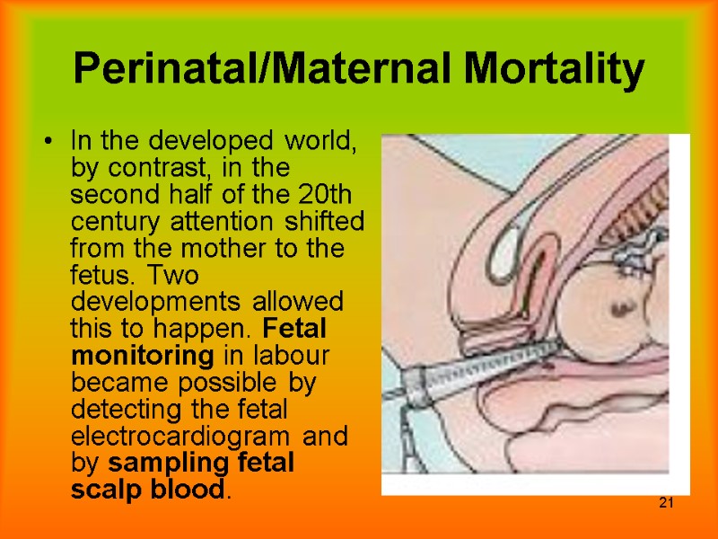 21 Perinatal/Maternal Mortality In the developed world, by contrast, in the second half of